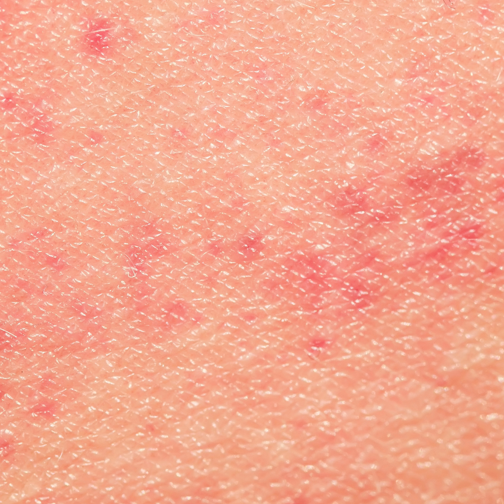 10 Essential Lifestyle Changes for Managing Eczema, Psoriasis, and Dermatitis